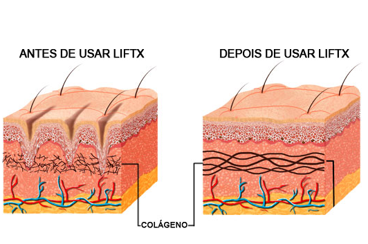 antes-depois-lift-x-8339991